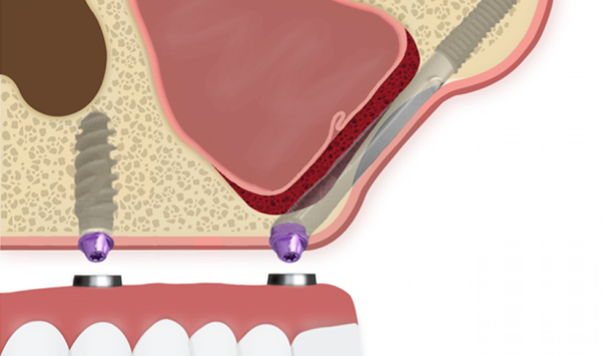 Zigoma İmplant Nedir?