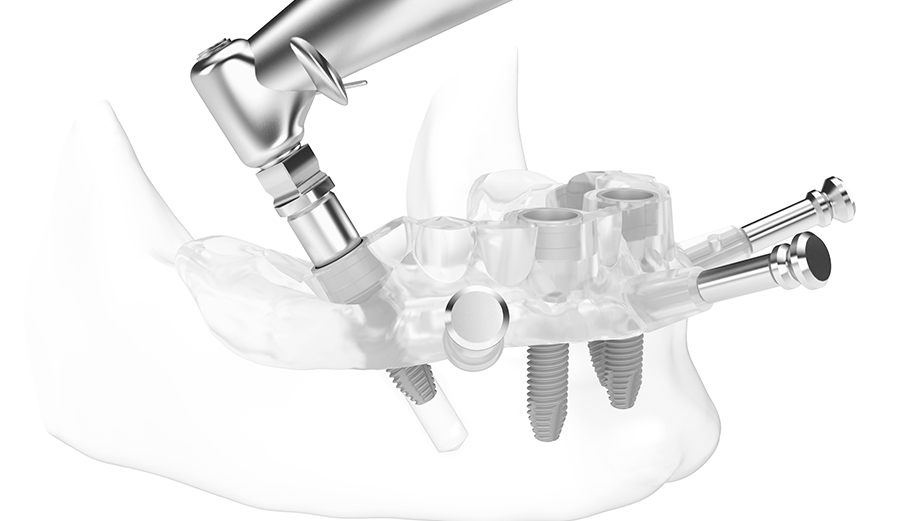 Advanced Implant Surgery