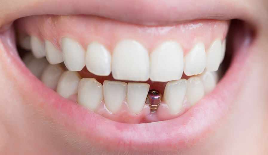 Dental Implant