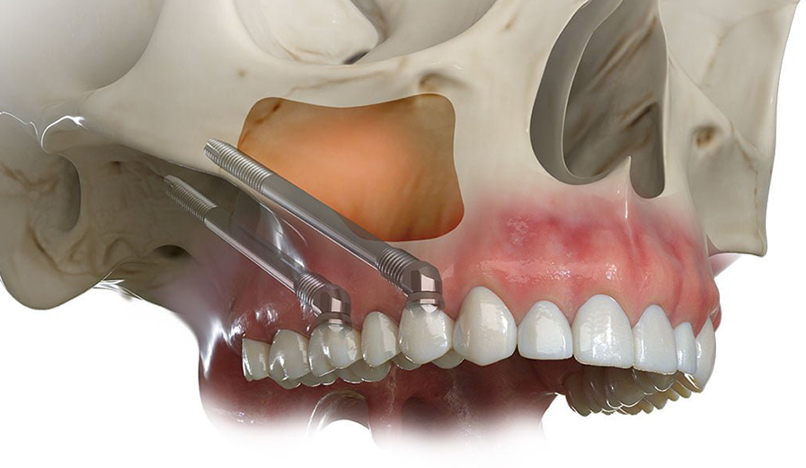 Zygomatic Implant
